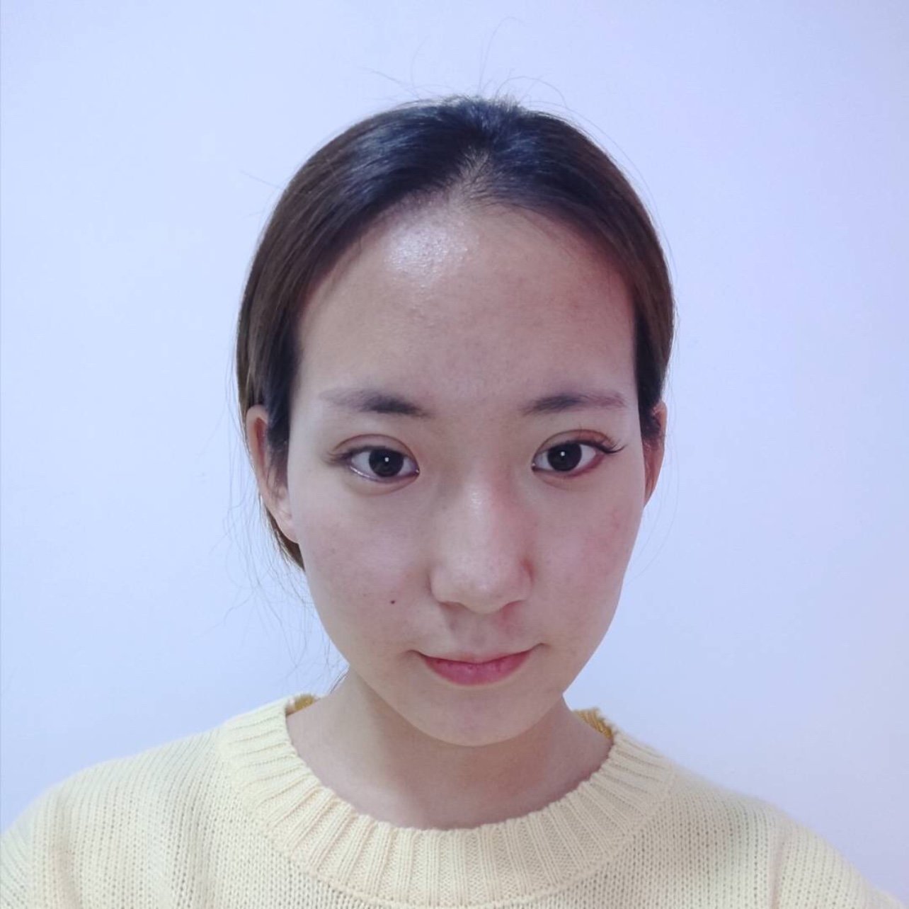 自己额头不饱满,就没福气,以前有去过微整形工作室注_圈子-新氧美容