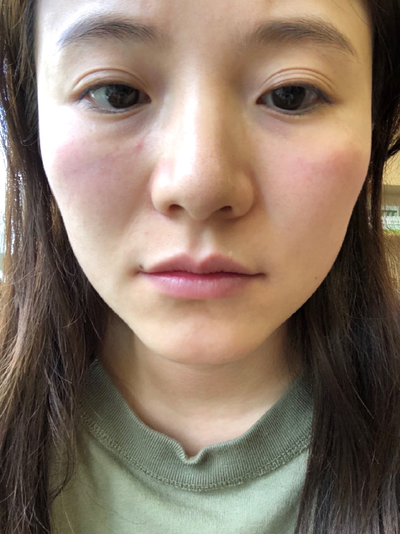 印第安纹有救了,,从去年出现泪沟,打了玻尿酸导致出_圈子-新氧美容