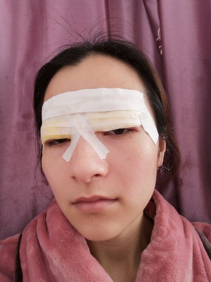 术后第2天:这是我术后第2天的样子,还蒙着纱布呢,好难受啊睁不开眼 