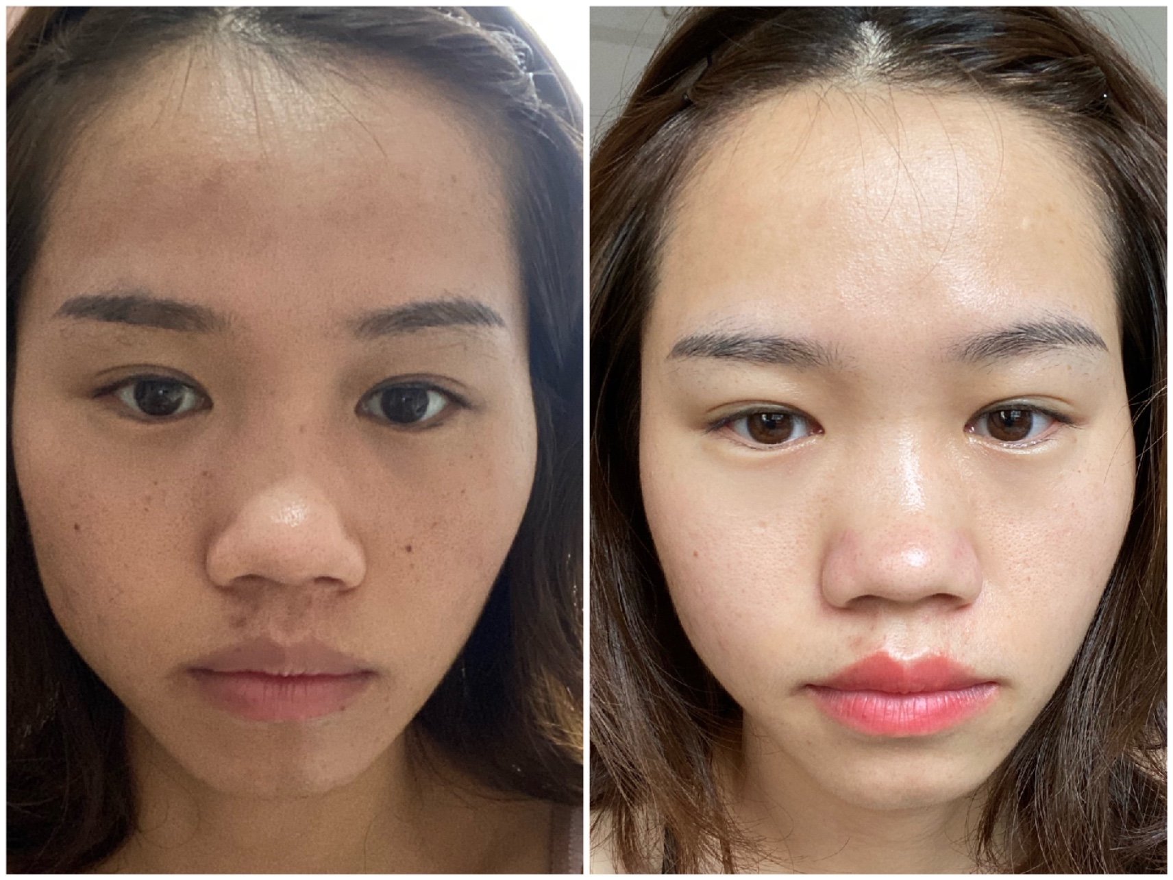 光子嫩肤后一周的效果图