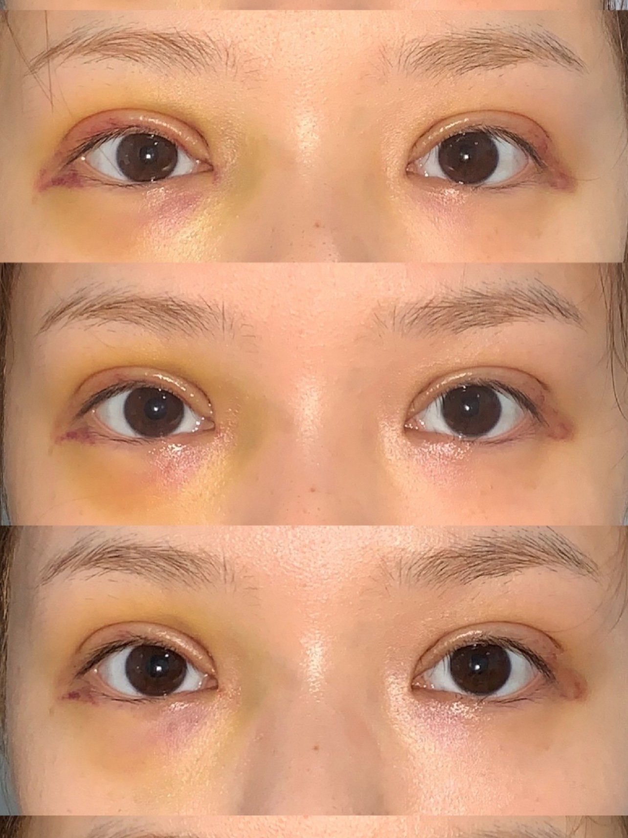 微创五点双眼皮前六天