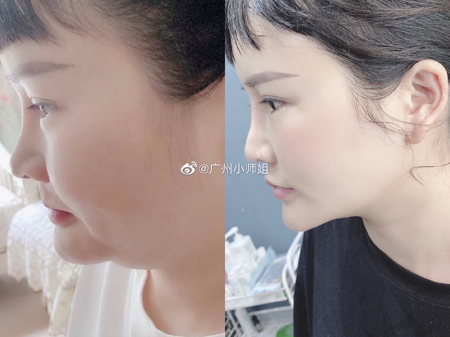新氧体验官面部吸脂77黄金微雕前后对比什么是黄金微_圈子-新氧