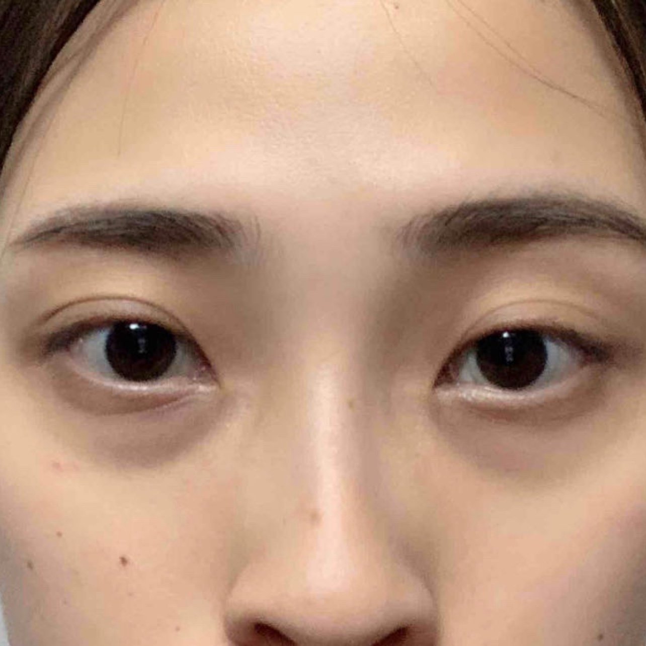 0869♀150869♀15玻尿酸填充泪沟原相机记录0869