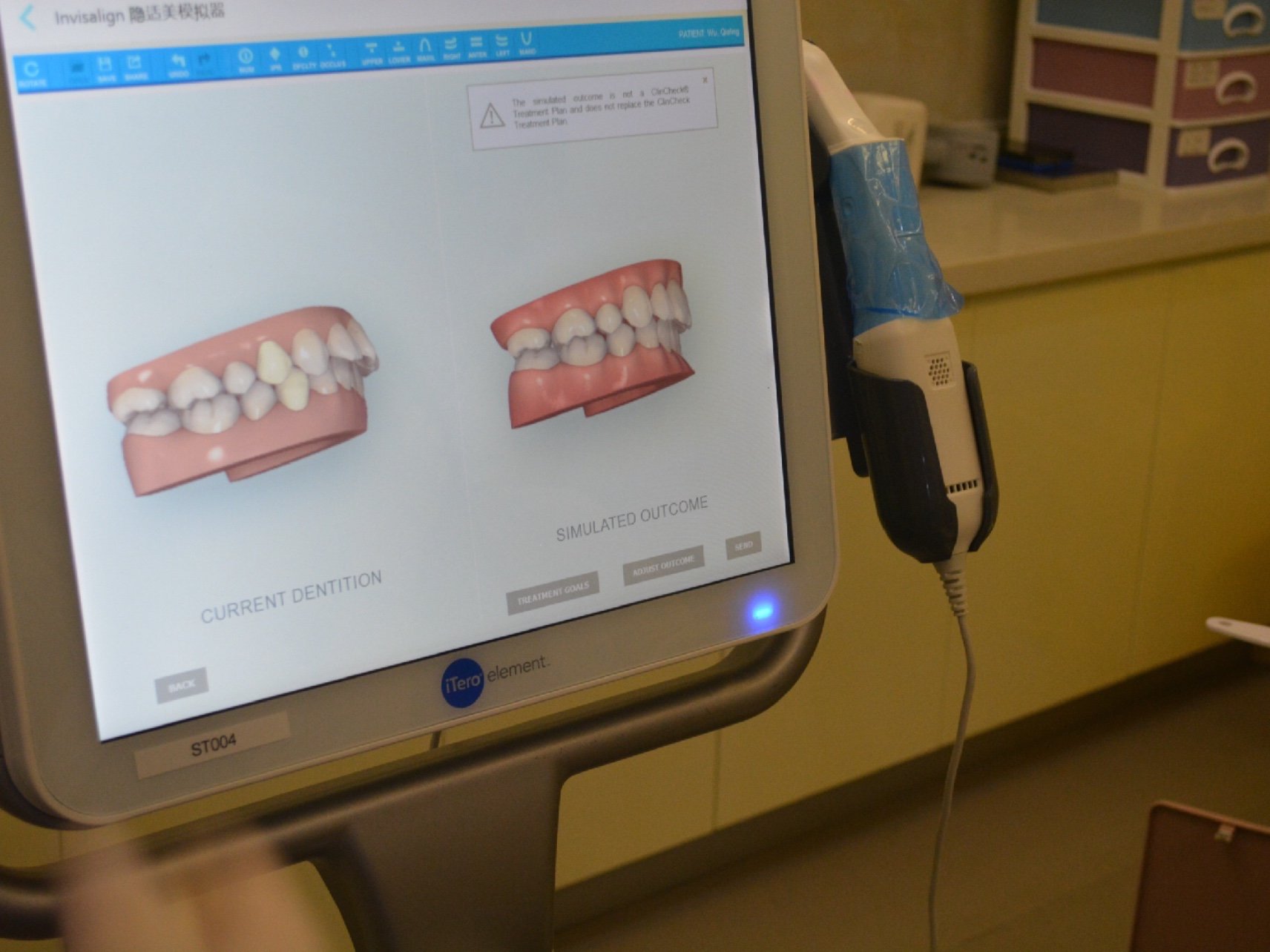 体验了一把口扫,能看到牙齿矫正后的样子,自己本身就_圈子-新氧美容