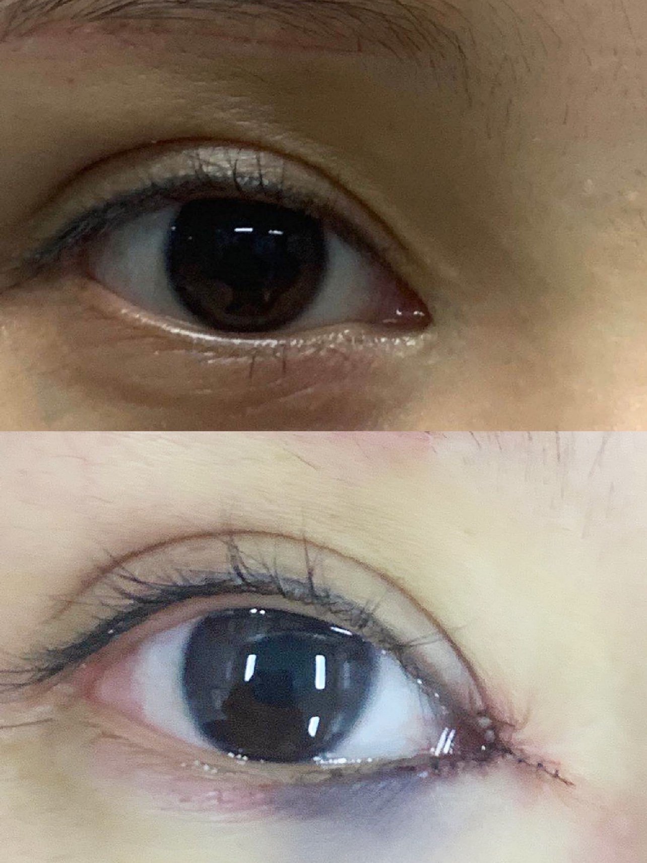 我觉得自己的内眼角太尖,整个人看起来不够柔和,有种_圈子-新氧美容