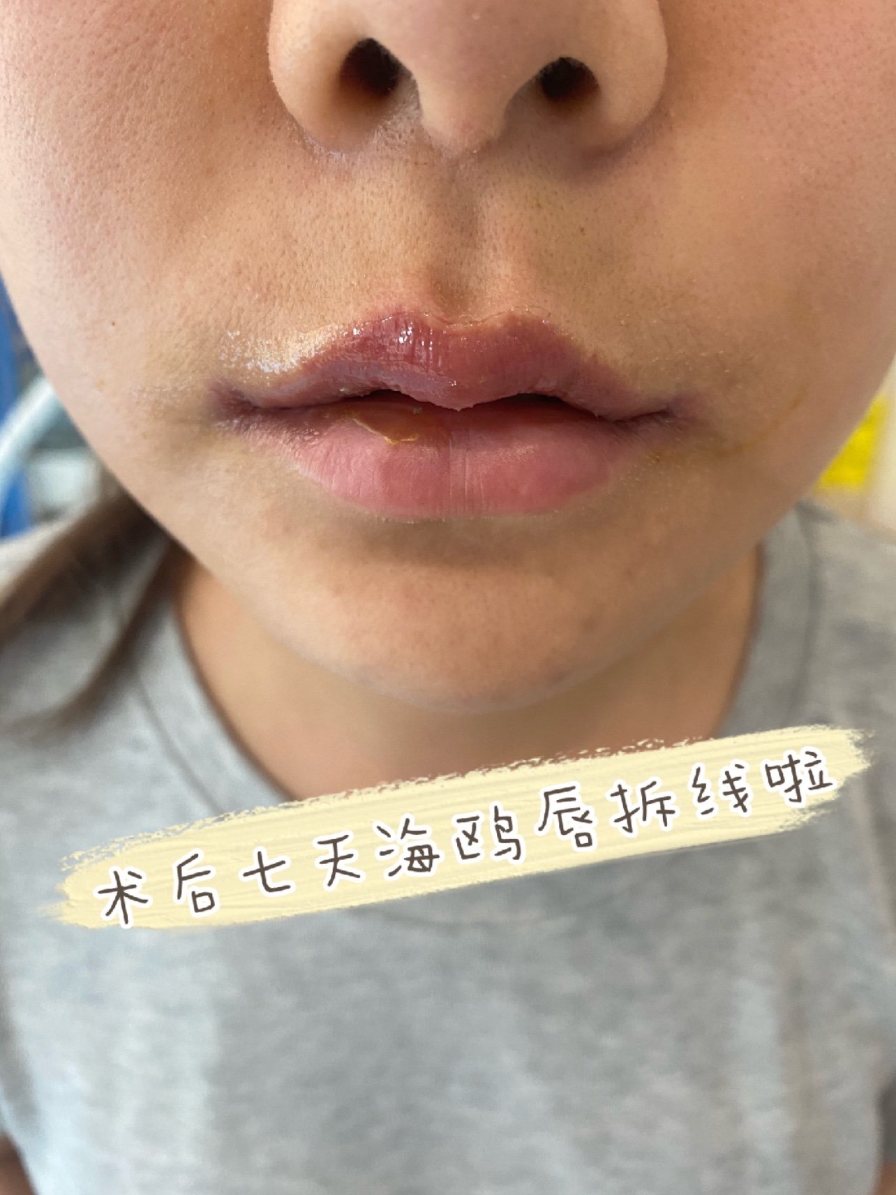 术后七天海鸥唇拆线啦06做完唇部手术已经七天了,按照_圈子-新氧