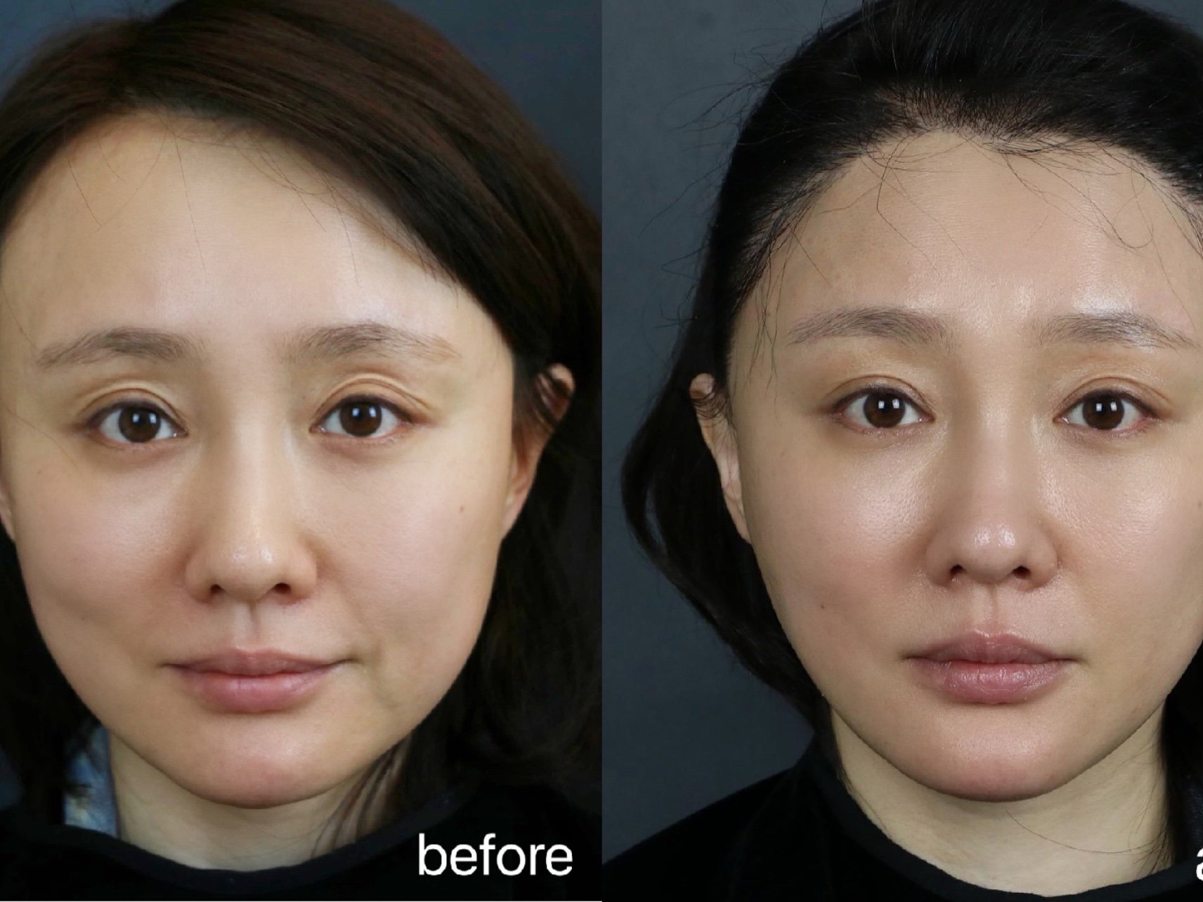 效果情况:线雕果然名不虚传,效果立竿见影,术后即刻_圈子-新氧美容