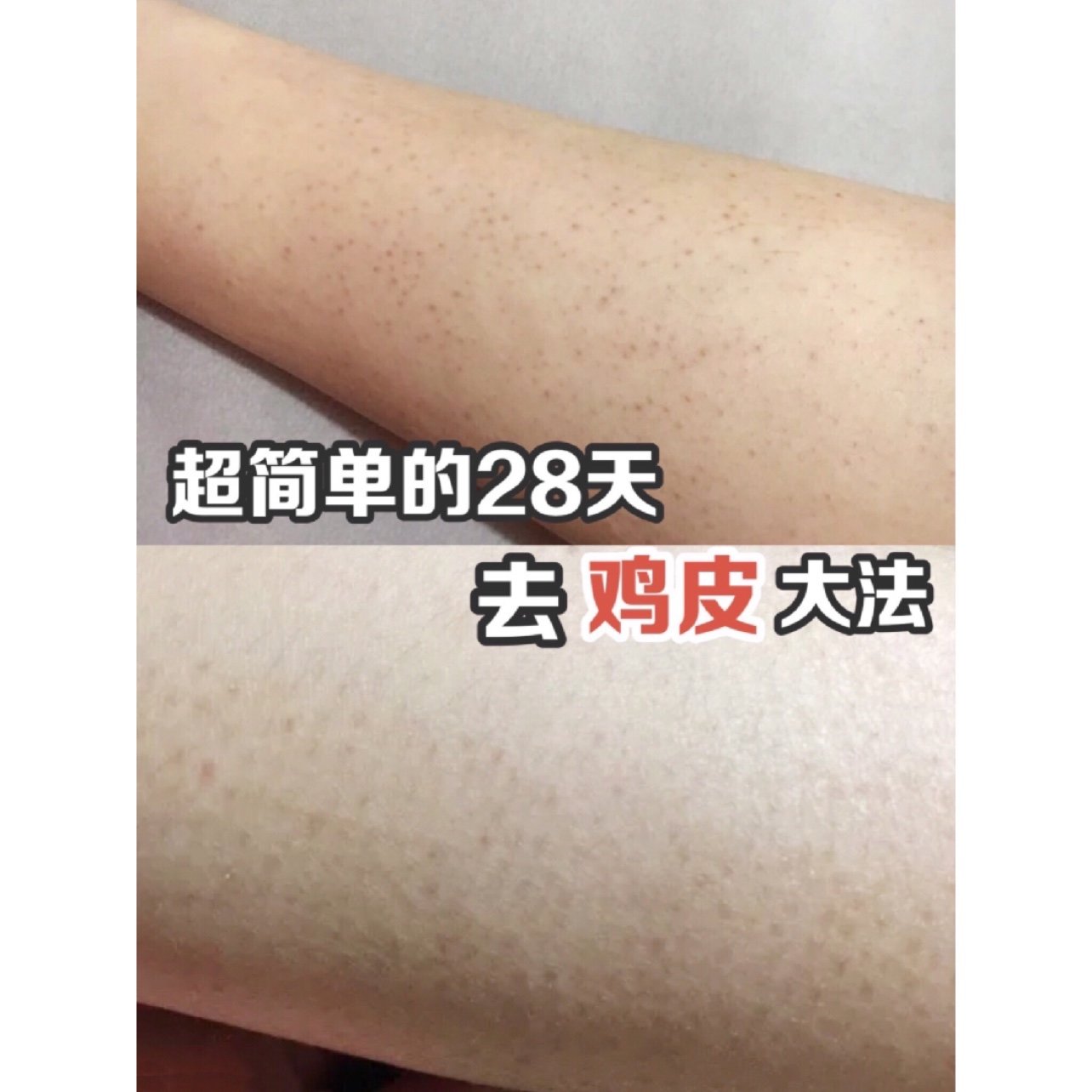 皮肤起鸡皮疙瘩发白(鸡皮疙瘩变白怎么回事)