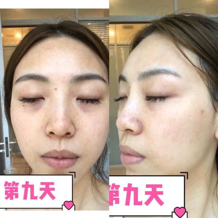 蜂巢皮秒77祛黄超详细体验