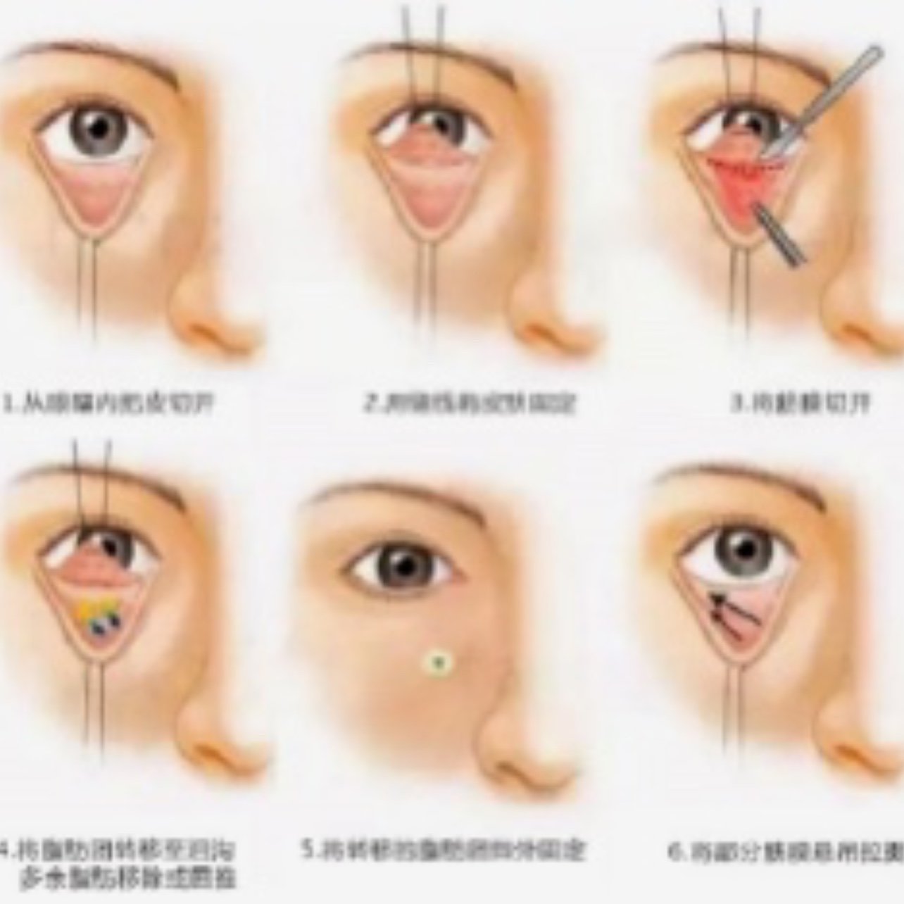 眶隔释放后的注意事项
