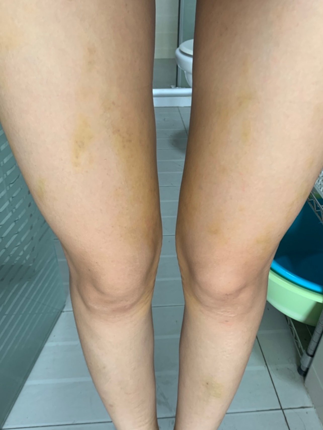 自体脂肪丰胸# #大腿吸脂# @脂肪超人卢