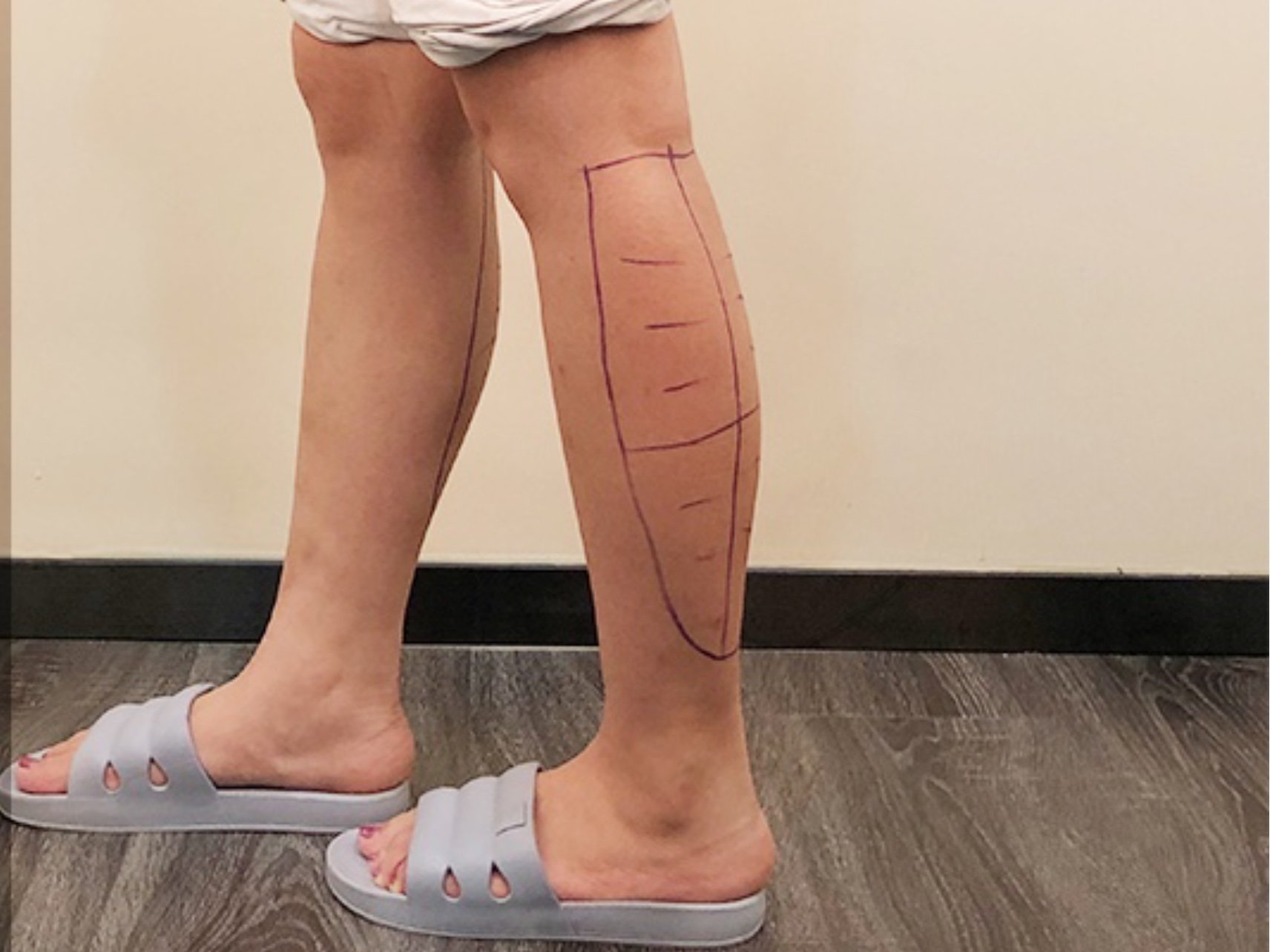 做完lams吸脂小腿已经有7天啦,这个效果简直太满意了,现在小腿后侧还