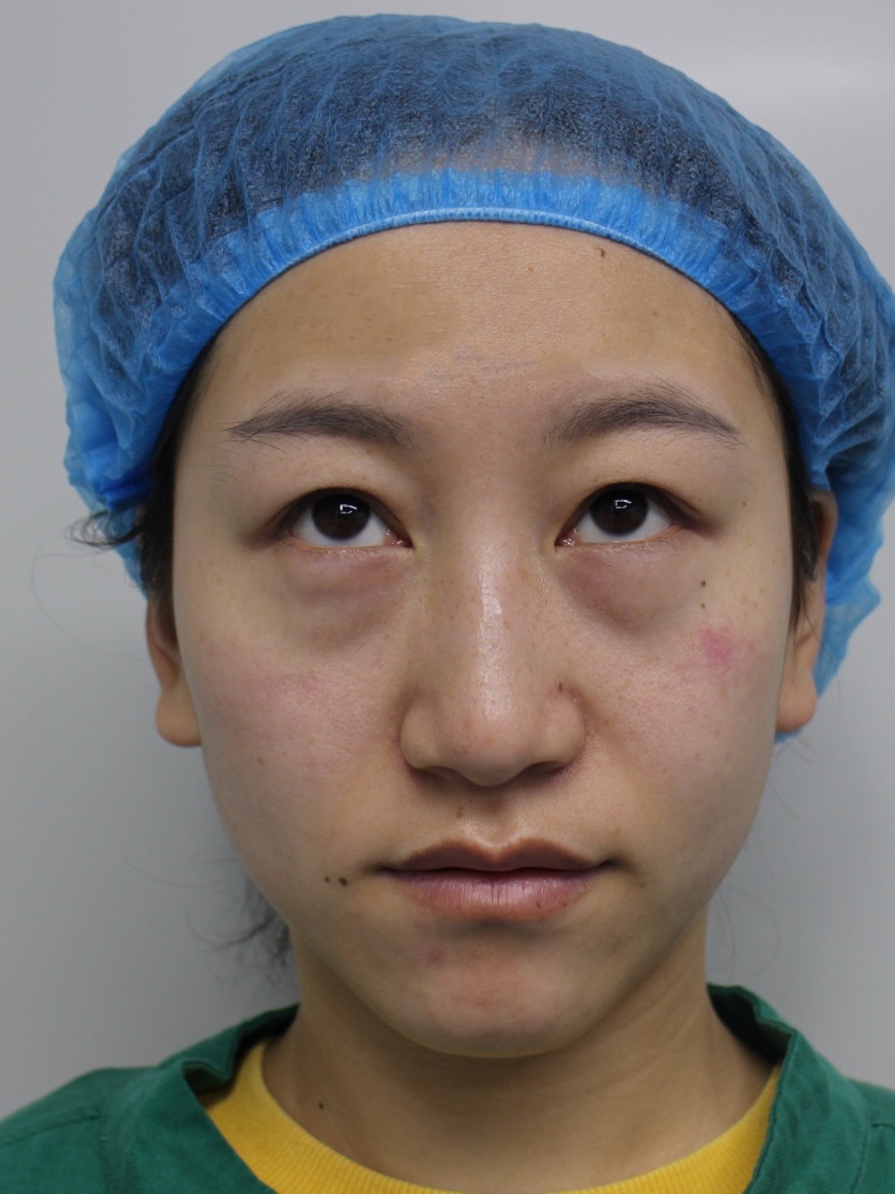 眼袋实在太大了,老早就像去掉了,但是以前害怕做手术_圈子-新氧美容