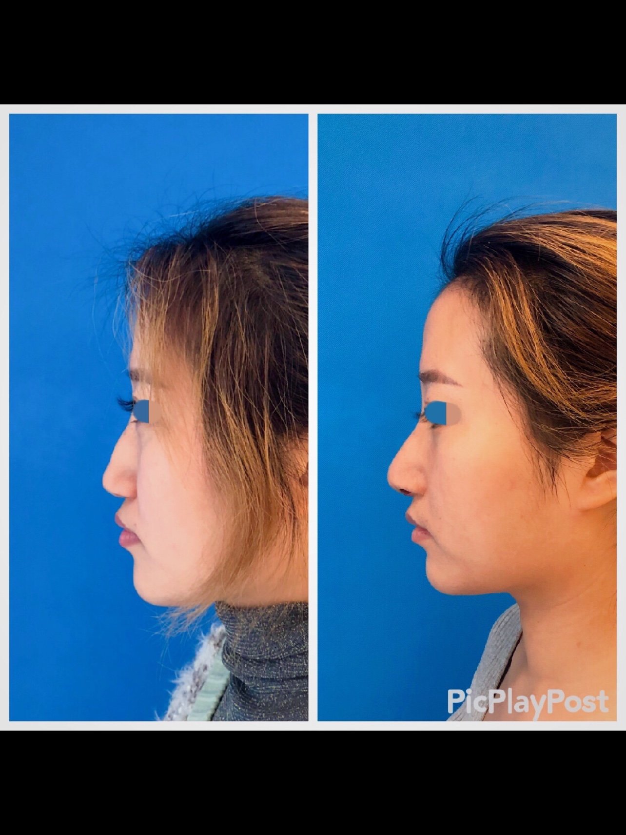 轻度驼峰鼻术后2周效果