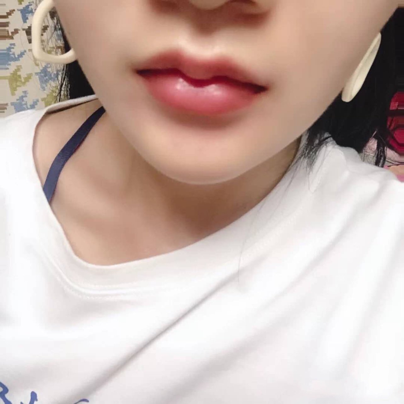 刚打完溶解酶,下巴的位置感觉平了很多自然了很多,没_圈子-新氧美容