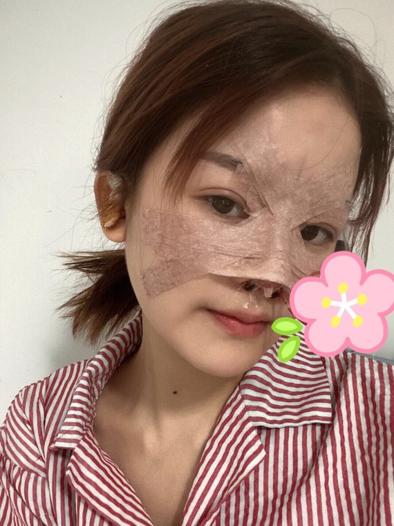 第二天,鼻子包着纱布不知道什么情况,感觉有点肿胀.