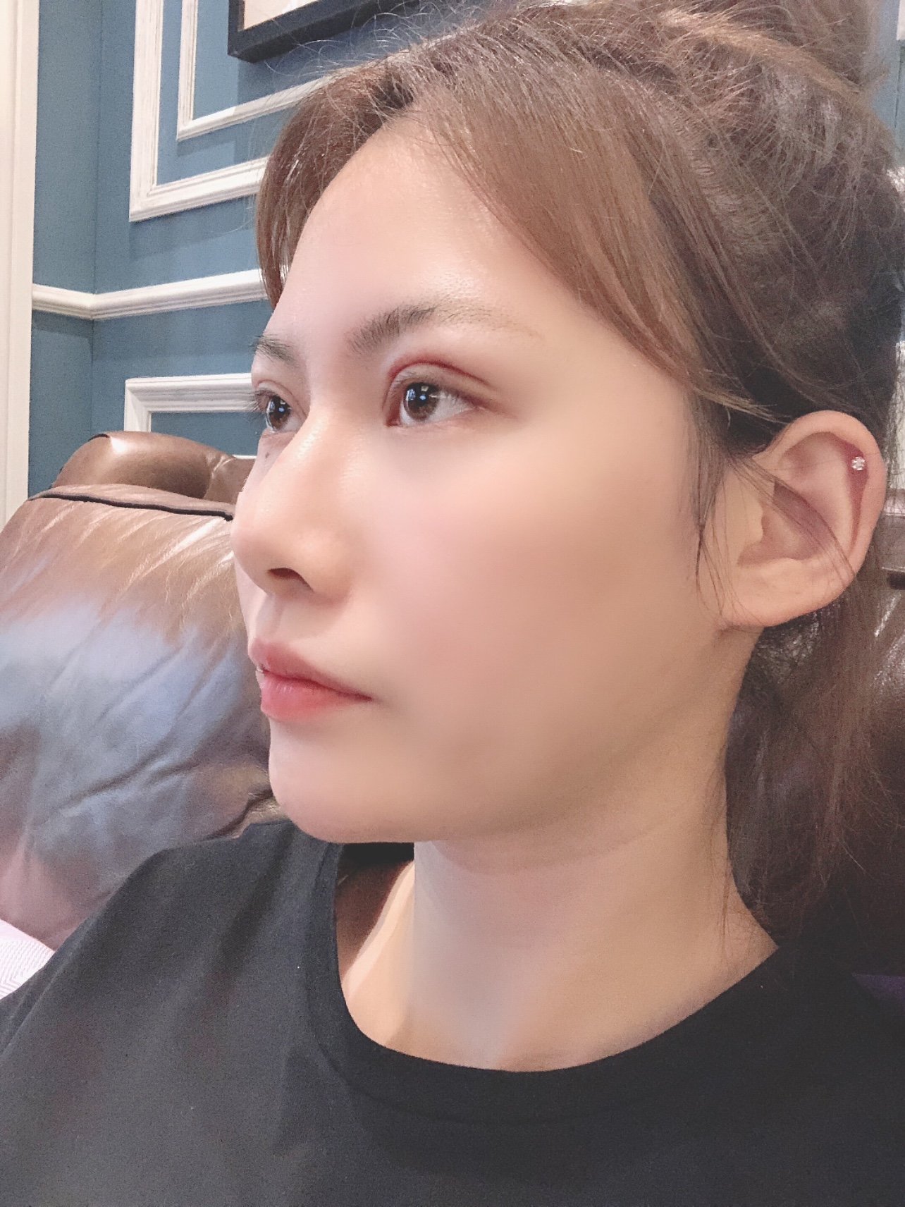 现在已经双眼皮第七天啦～眼睛基本消肿且越来越自然了_圈子-新氧美容