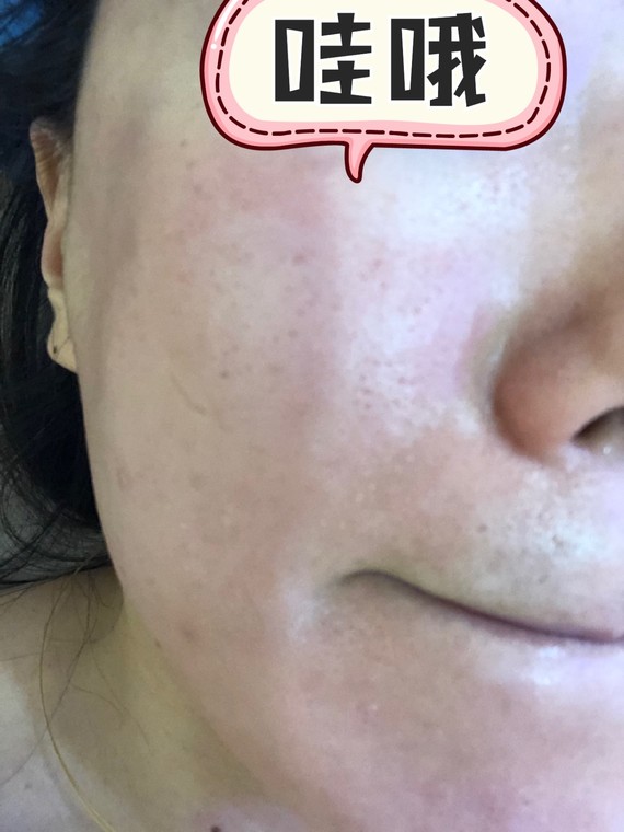 第一次刷酸#好像烂掉了