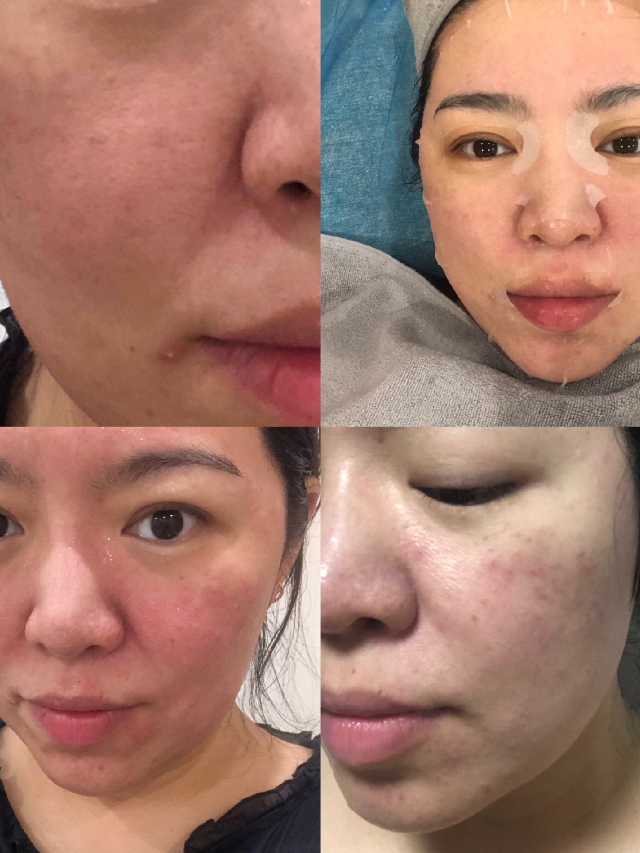 【新氧体验官】大油田的首次刷酸体验 给了法国的迪玛丝缇