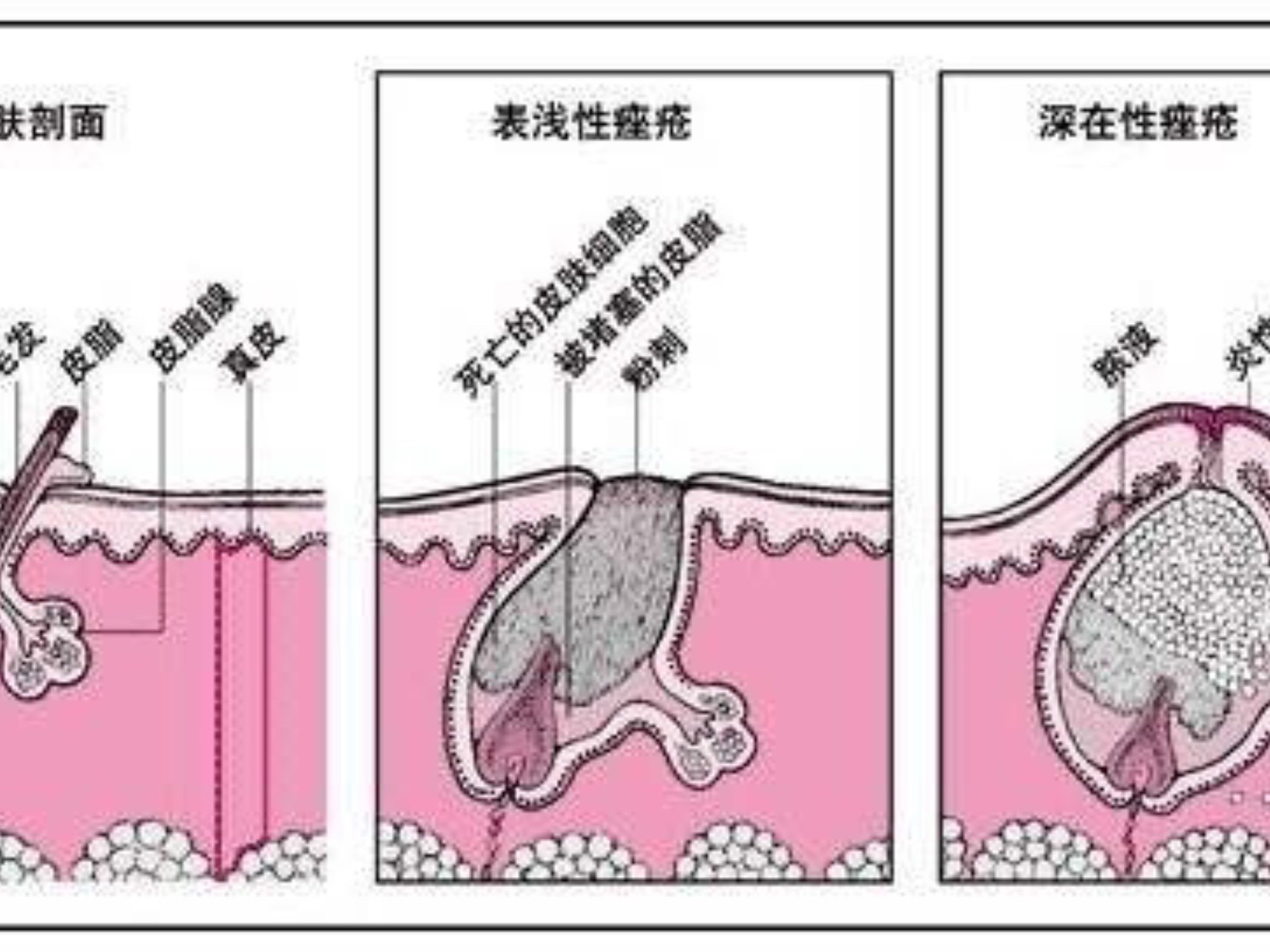 黑头闭口粉刺的区别图片