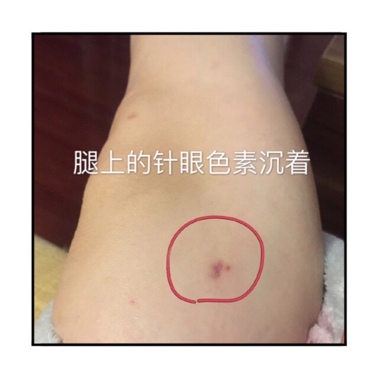 大腿抽脂针眼疤痕图片图片