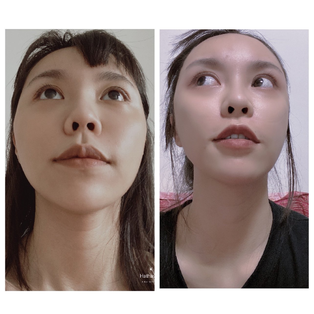 颧骨颧弓内推术后60天#颧骨内推