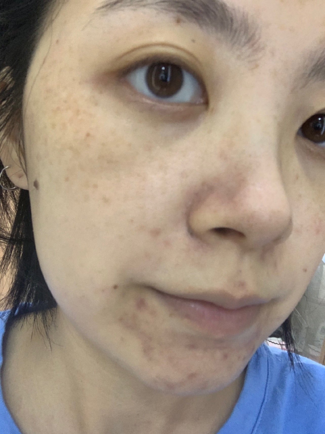 不会是大面积那种深色斑! 刚做完还挺疑惑,好像没效果?