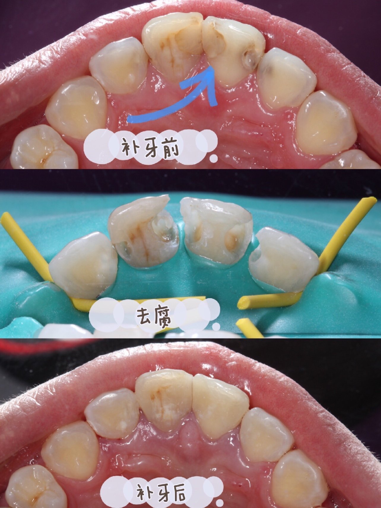 门牙有蛀牙蛀空损坏了一半?是做补牙还是贴面修复?