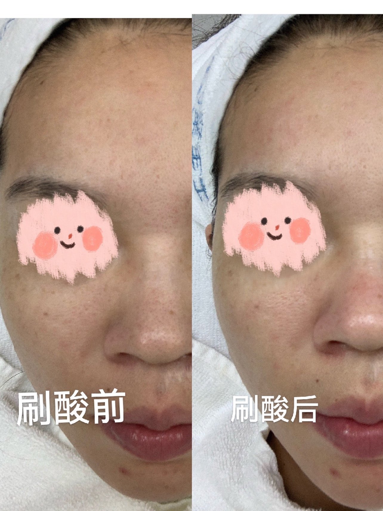 新氧体验官 第一次刷酸真实效果分享