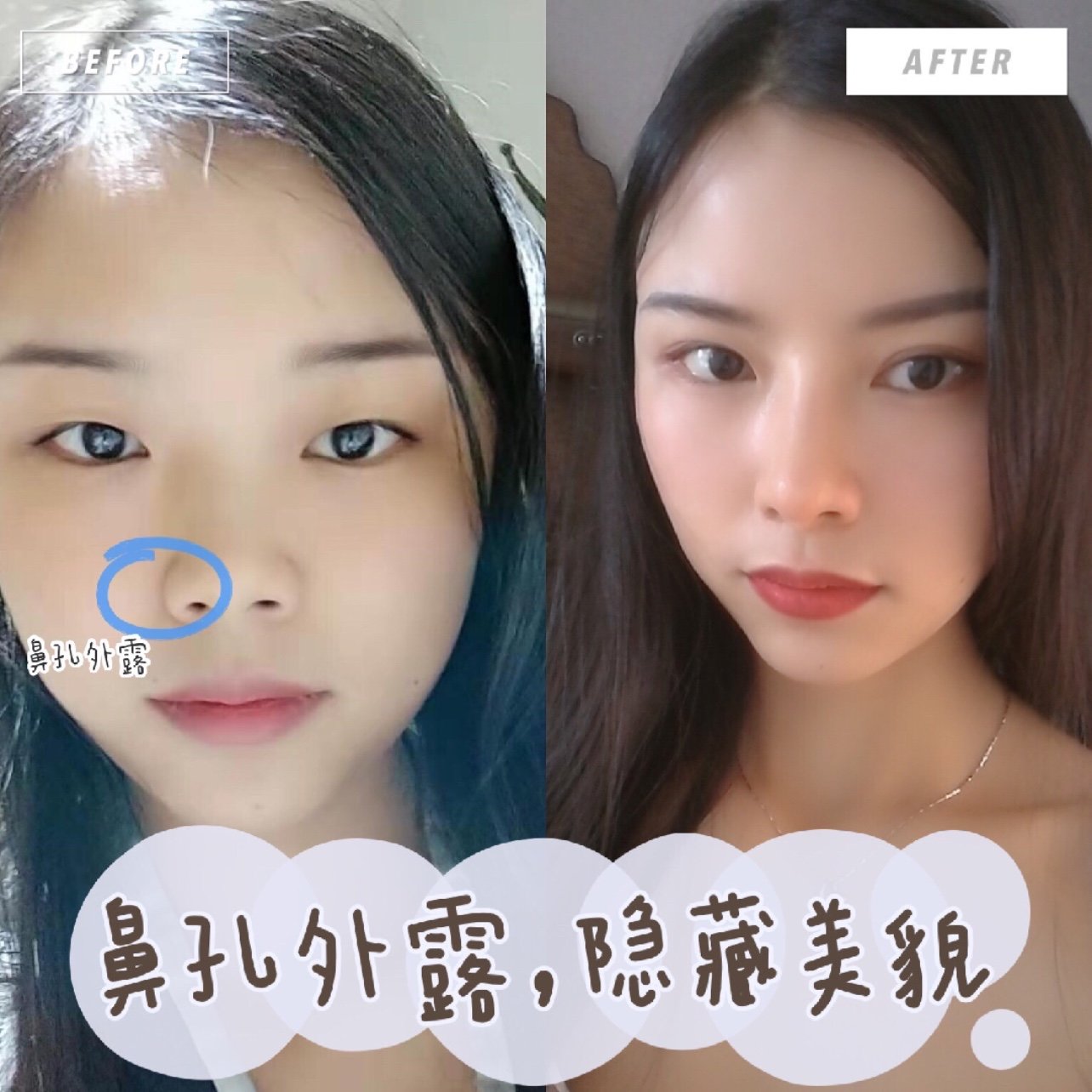 9199鼻头扁平和鼻孔外露很容易显得土气,立体感不足,_圈子-新氧