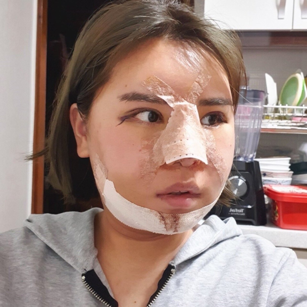 今天是术后第4天,脸肿的还像个包子一样,可能是