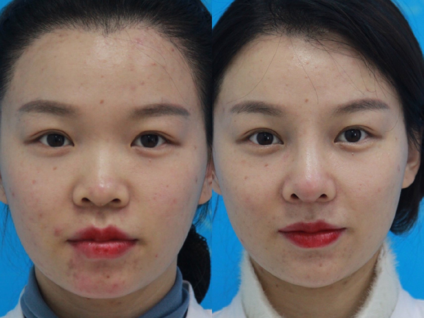 【术前诊断】:患者自小塌鼻梁,鼻头位置塌陷也比较重_圈子-新氧美容