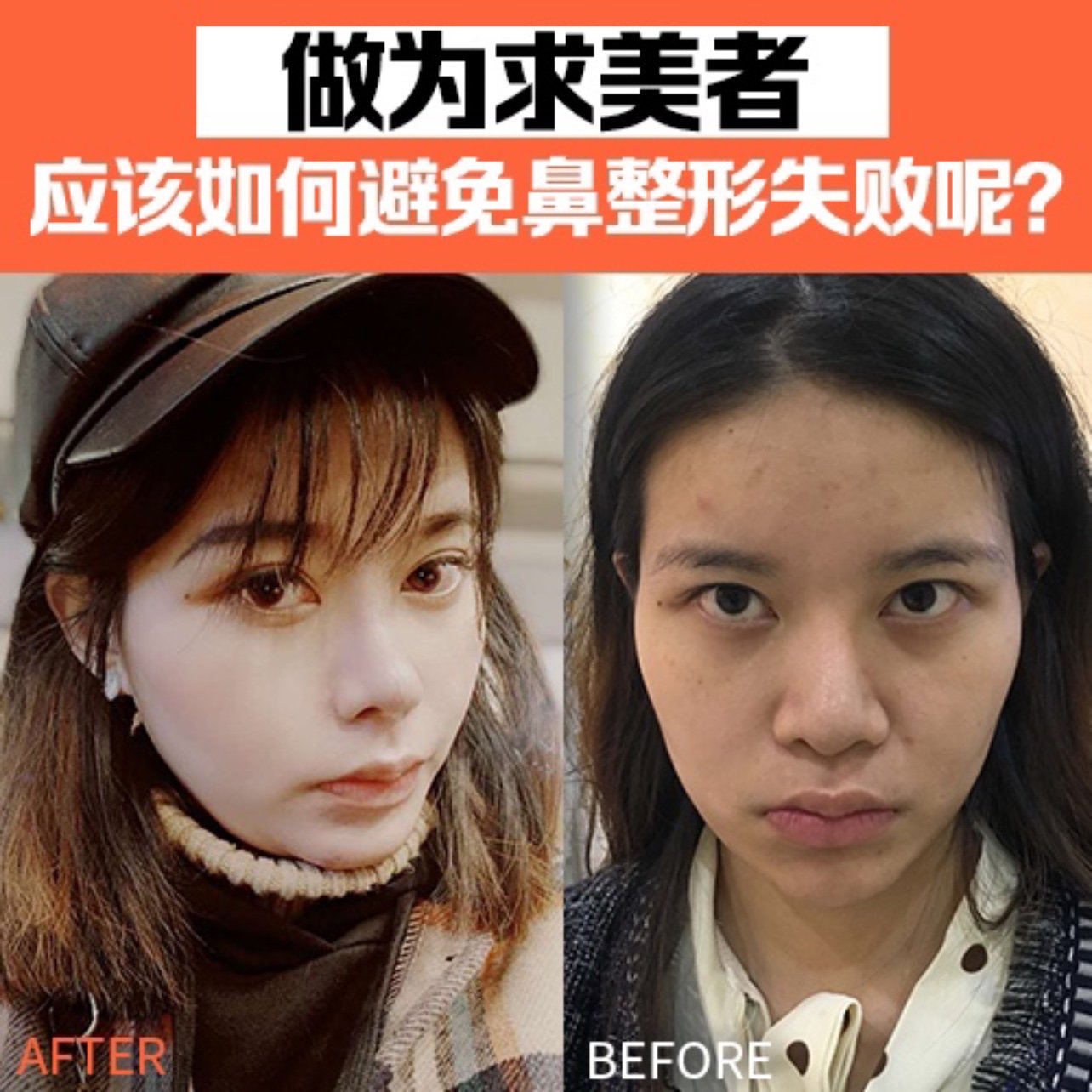 做为求美者 应该如何避免鼻整形失败 圈子 新氧美容整形