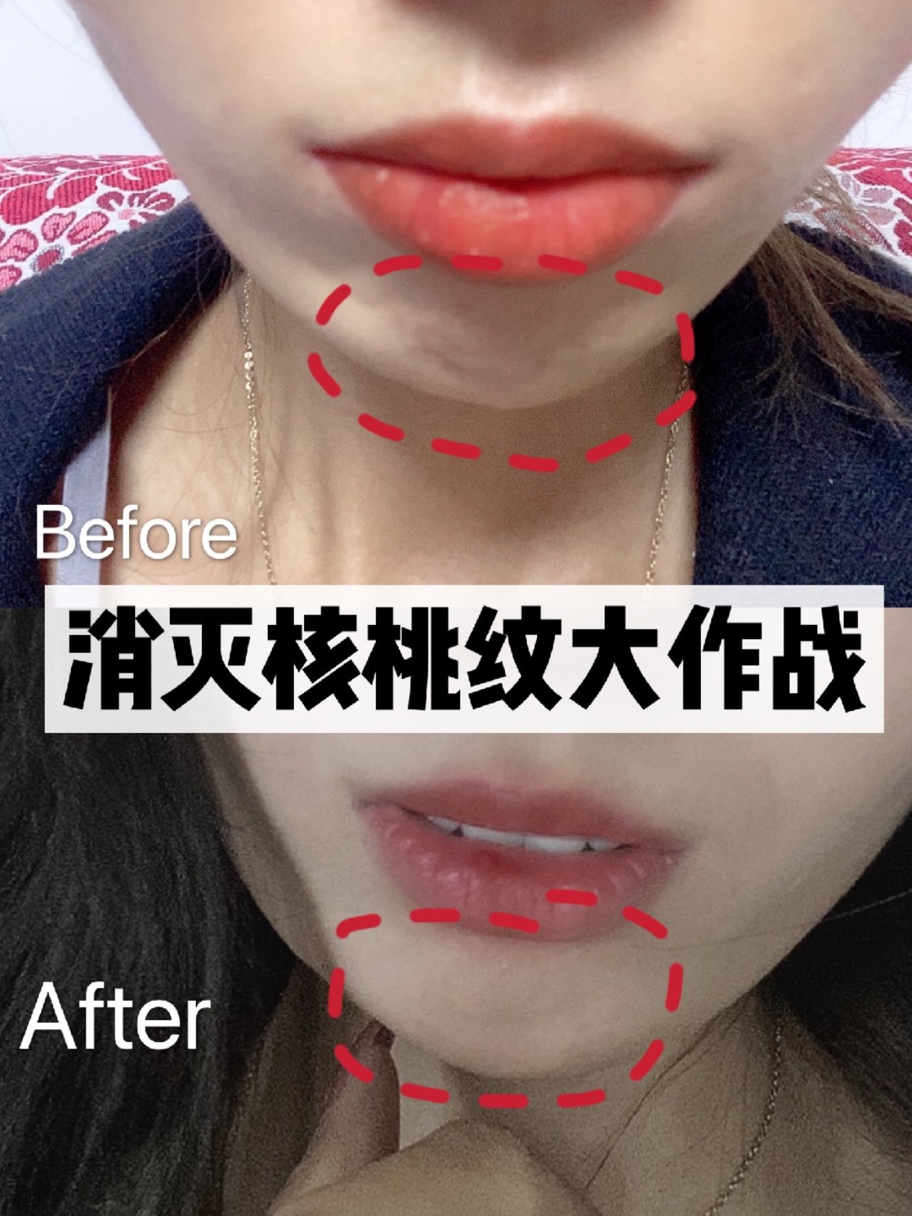 大家有没有发现,在你嘴巴自然闭上的时候下巴上就会有像核桃一样的