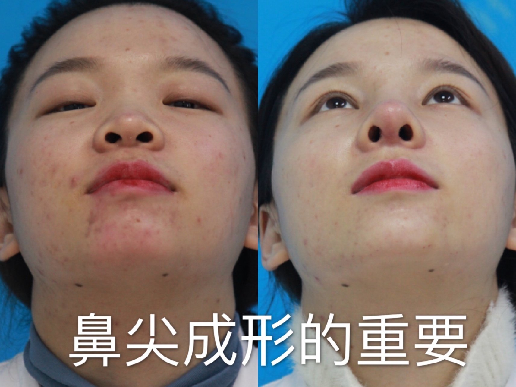 鼻尖修正（鼻尖形成・鼻尖縮小） | 池袋の美容皮膚科・美容外科なら「みずほクリニック」