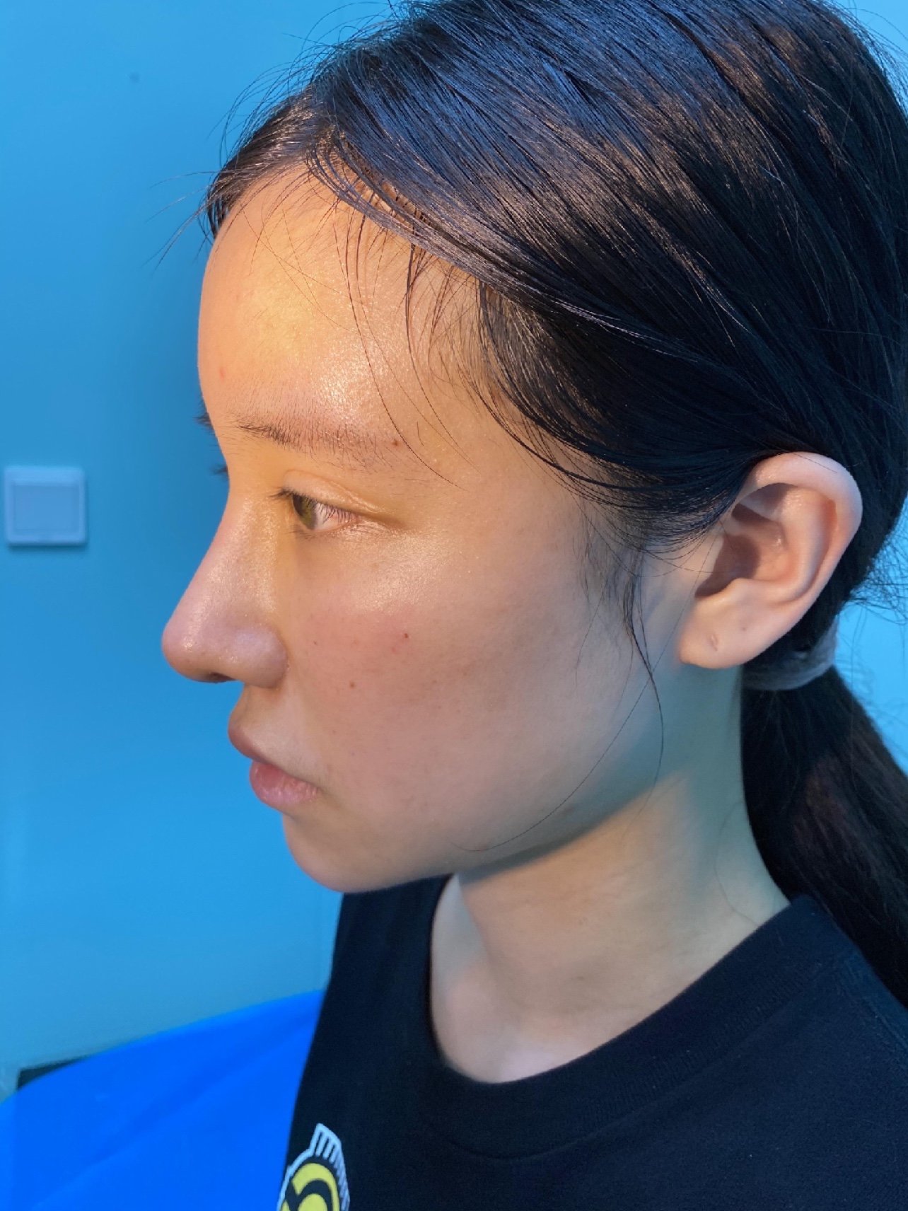 【贾德渊半肋骨隆鼻术后第7天】