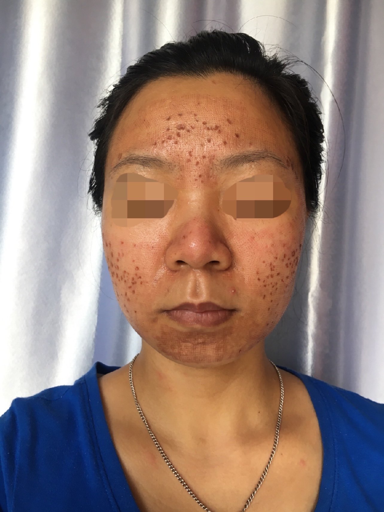 点阵激光第二天