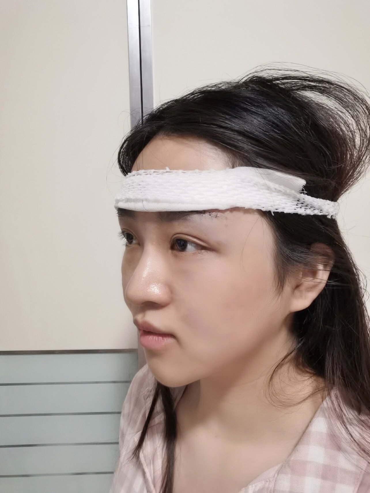 眉弓处略肿胀,垫的3mm的比较自然,肿胀程度可以接受,疼痛感适中.