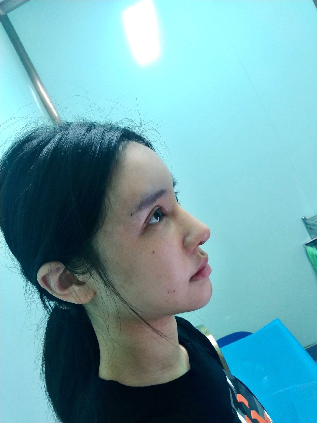 【贾德渊半肋骨隆鼻术后第7天】