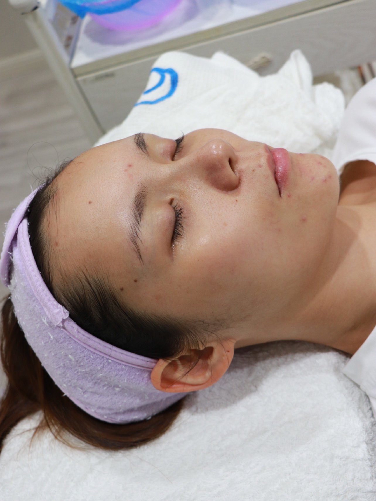 【新氧体验官】刷酸小白体验肉眼看见效果的焕颜奇术?