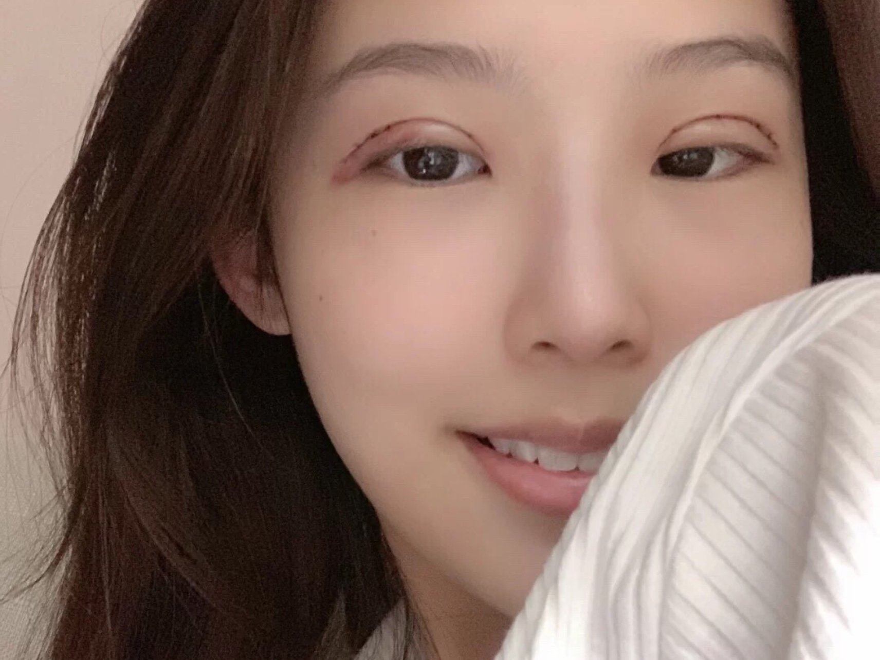 割双眼皮手术报道
