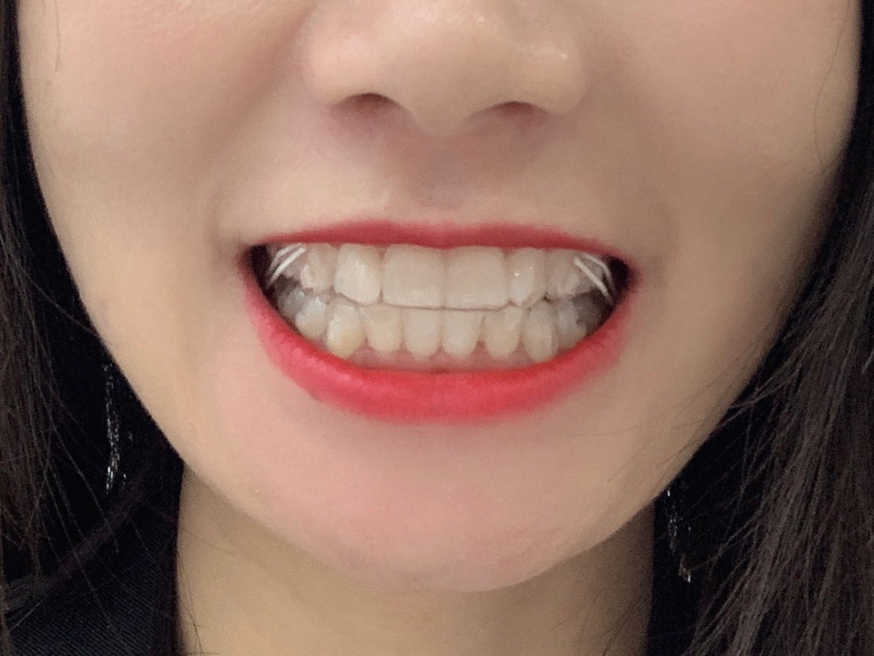 新氧试用官 隐形牙套 从小换牙的时候没有注意,门_圈子-新氧美容整形