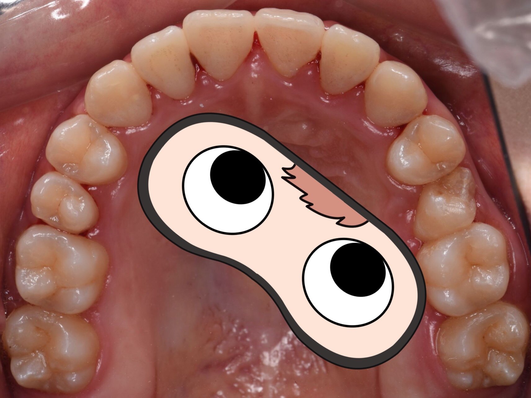 我是大龅牙,嘴巴自然闭合状态特别不自然,牙齿拥挤,