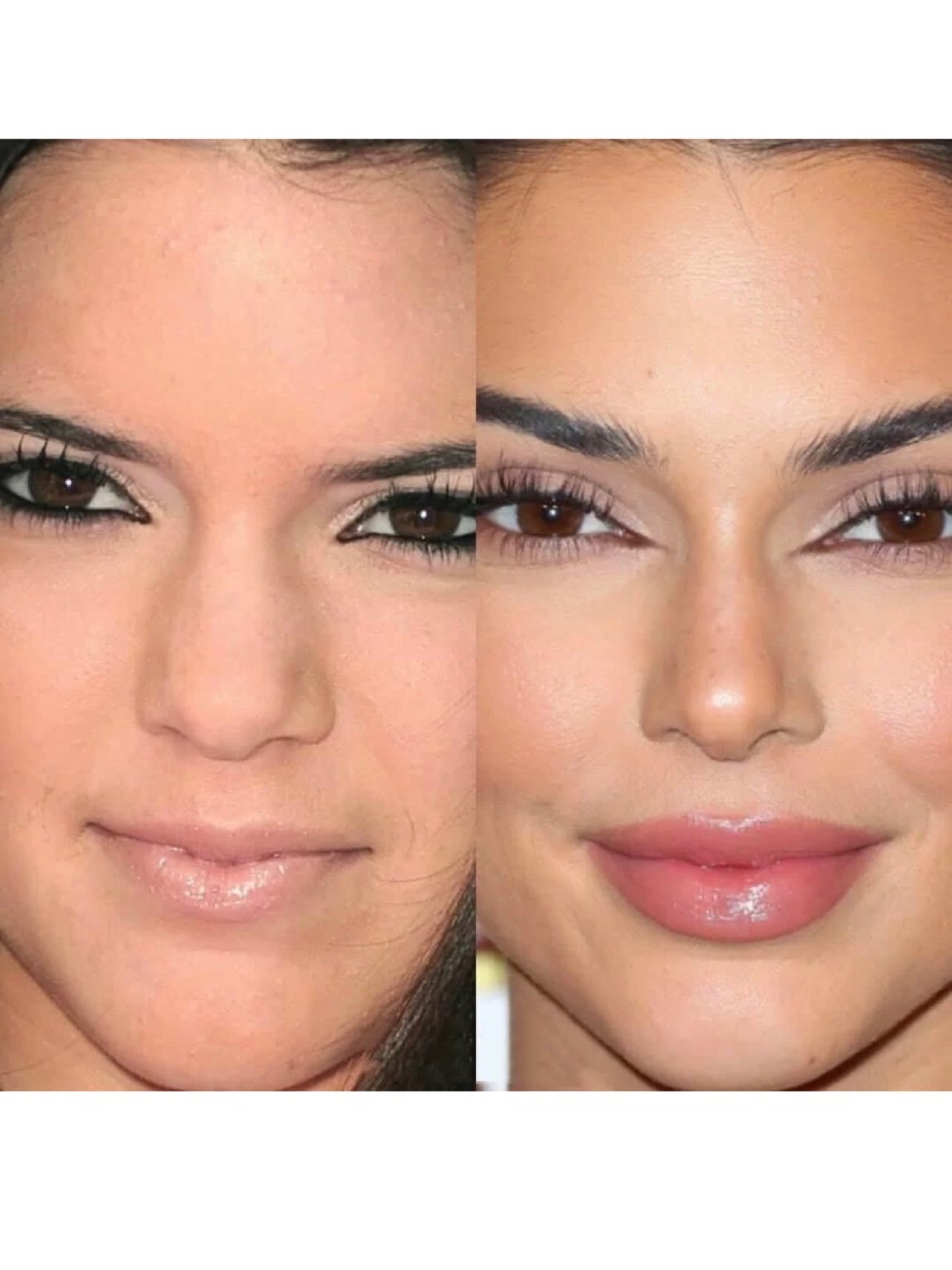 1鼻梁收窄:肯豆最明显的一个改变就是鼻子.