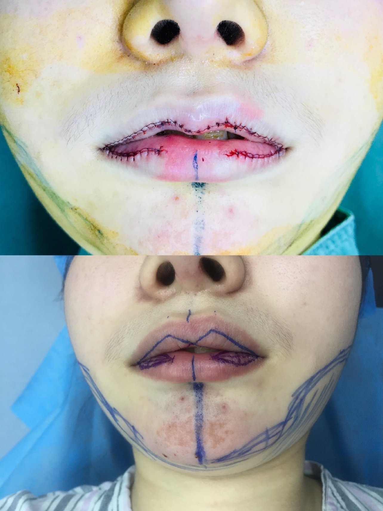 唇部综合手术术后第一天