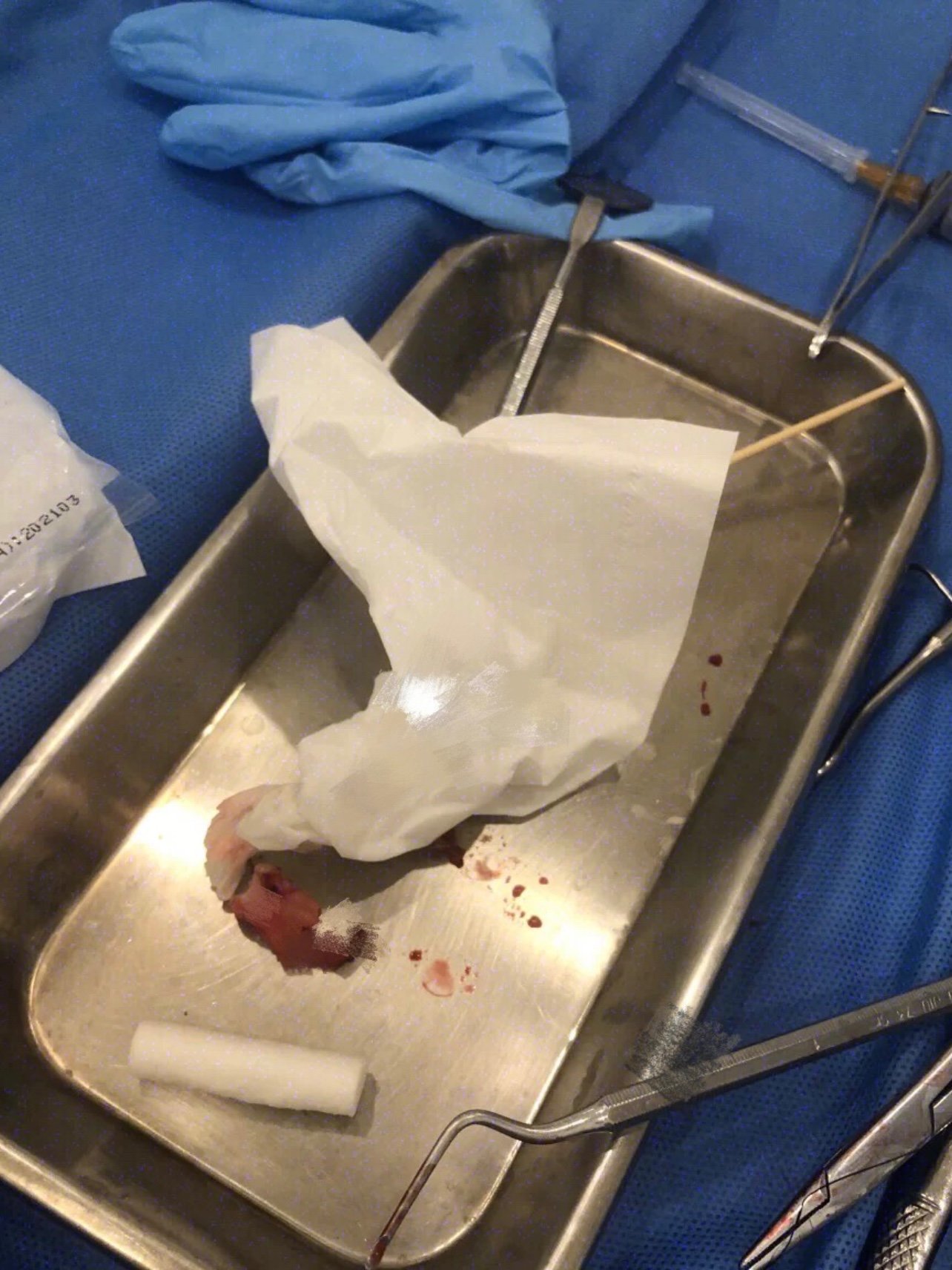 首先拍片拔出坏牙,然后就是一些常规检查,合格以后就_圈子-新氧美容