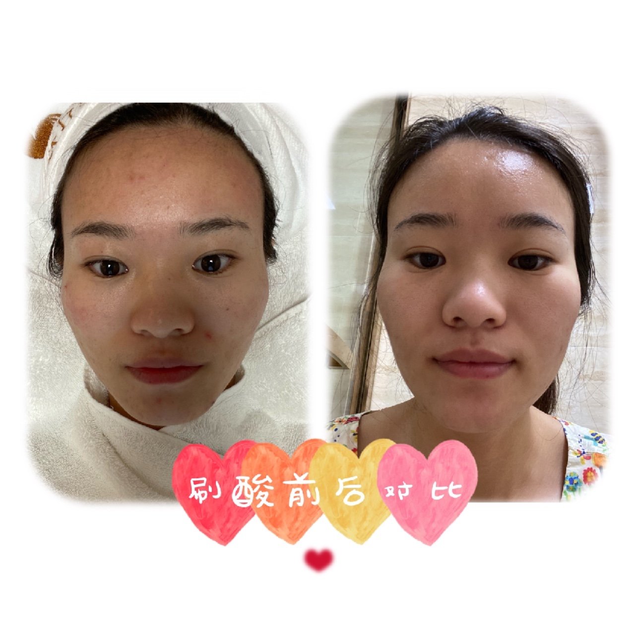 刷酸三天前后对比