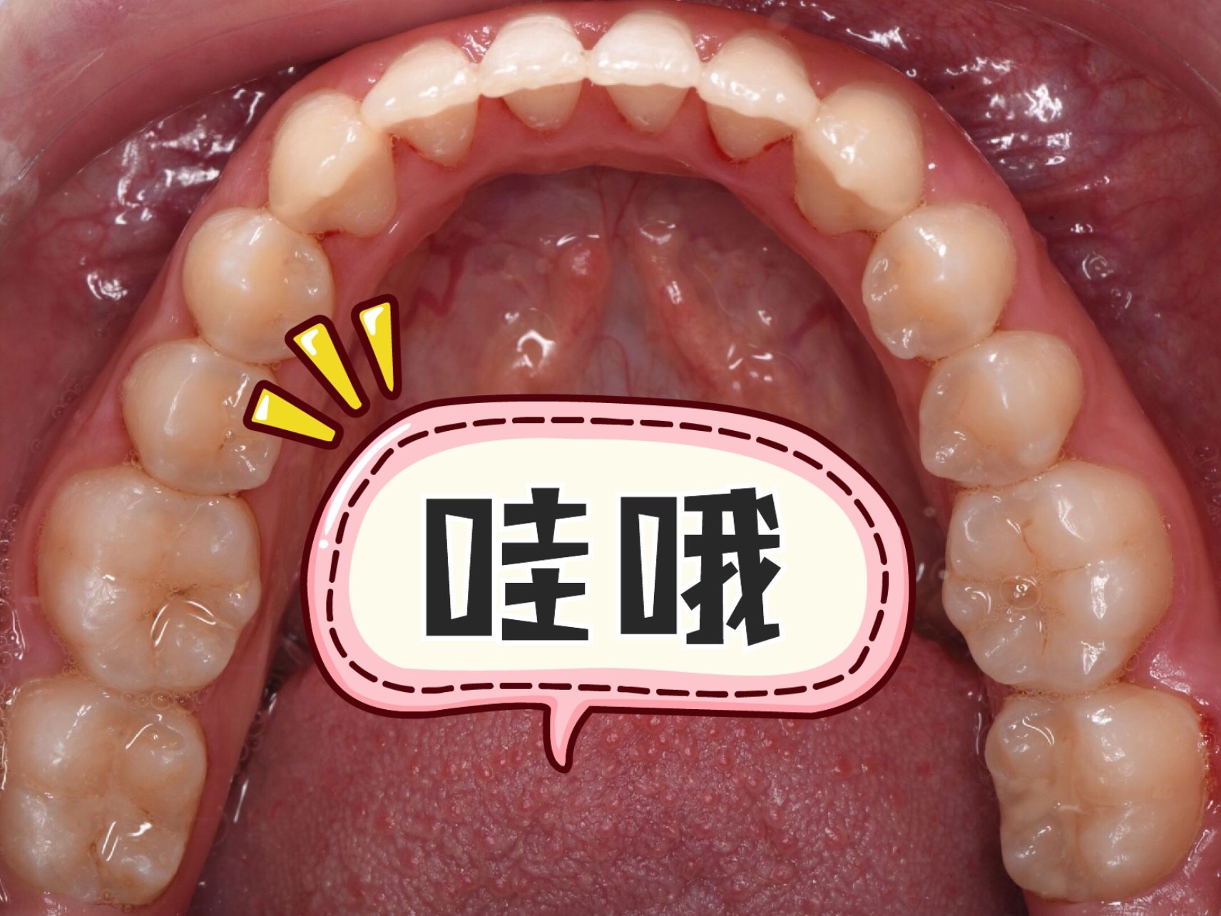 我是大龅牙,嘴巴自然闭合状态特别不自然,牙齿拥挤,_圈子-新氧美容