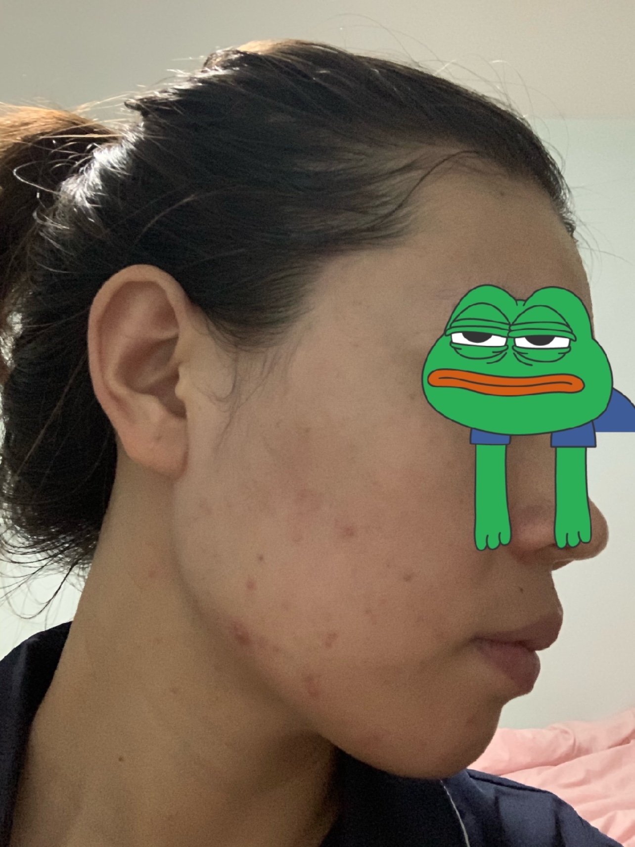 这次主要分享下刷酸之后皮肤会出现的状况