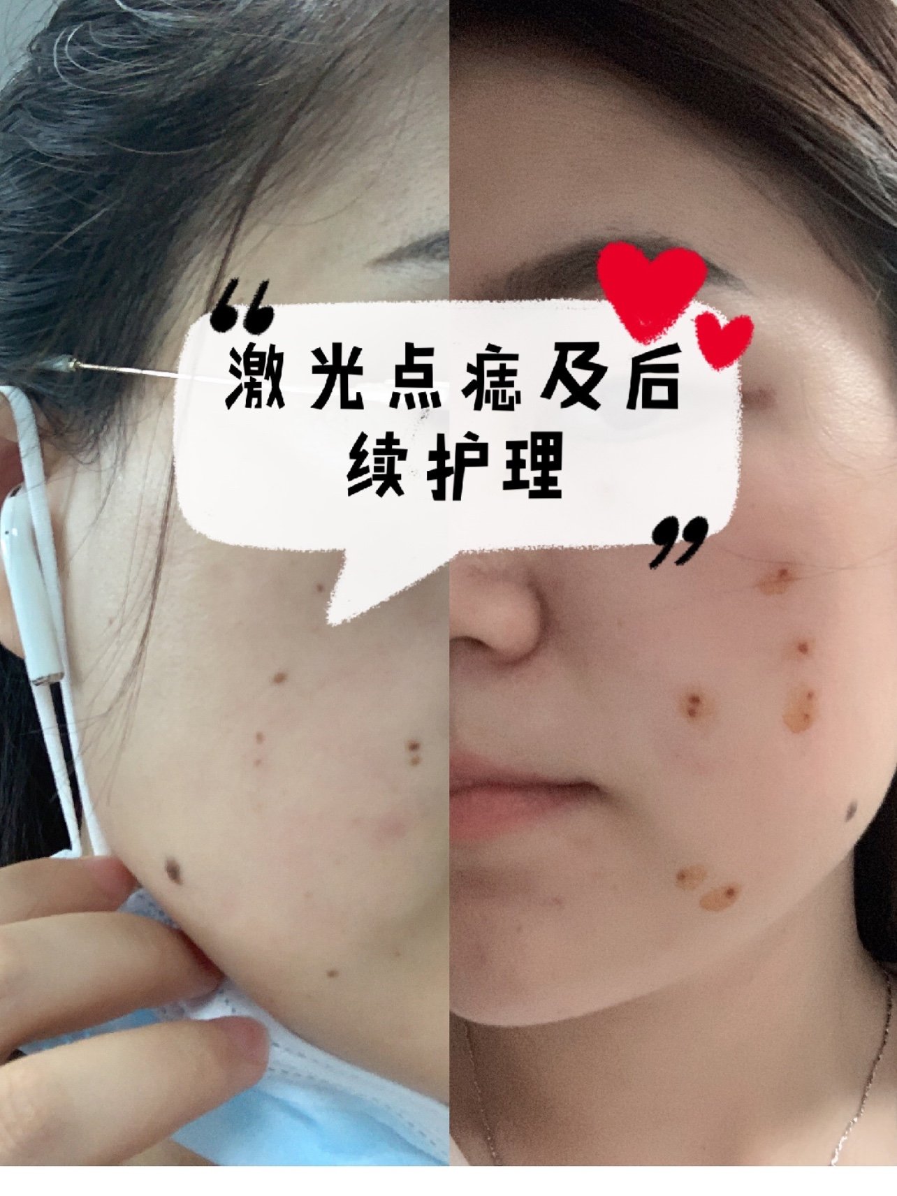 上周天去医院做了激光点痣,下面我来讲讲整个过程和后续护理吧